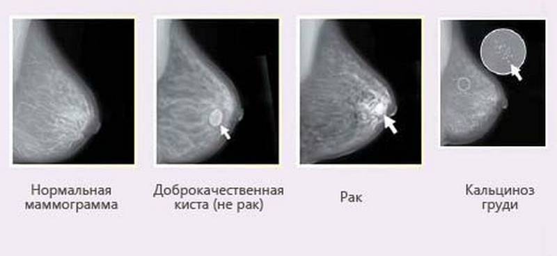 Диагностика молочной железы: узи и другие обследования