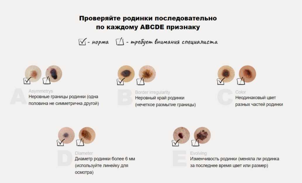 Как отличить родинку от папилломы