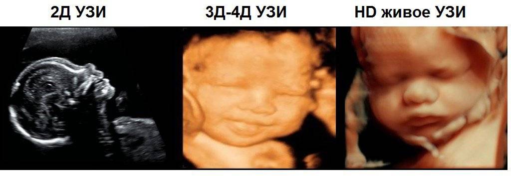 Узи при беременности в 3d- и 4d режимах, особенности и возможности