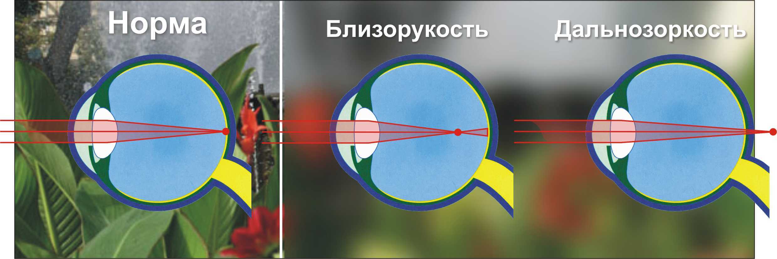 Что такое близорукость и дальнозоркость простыми словами