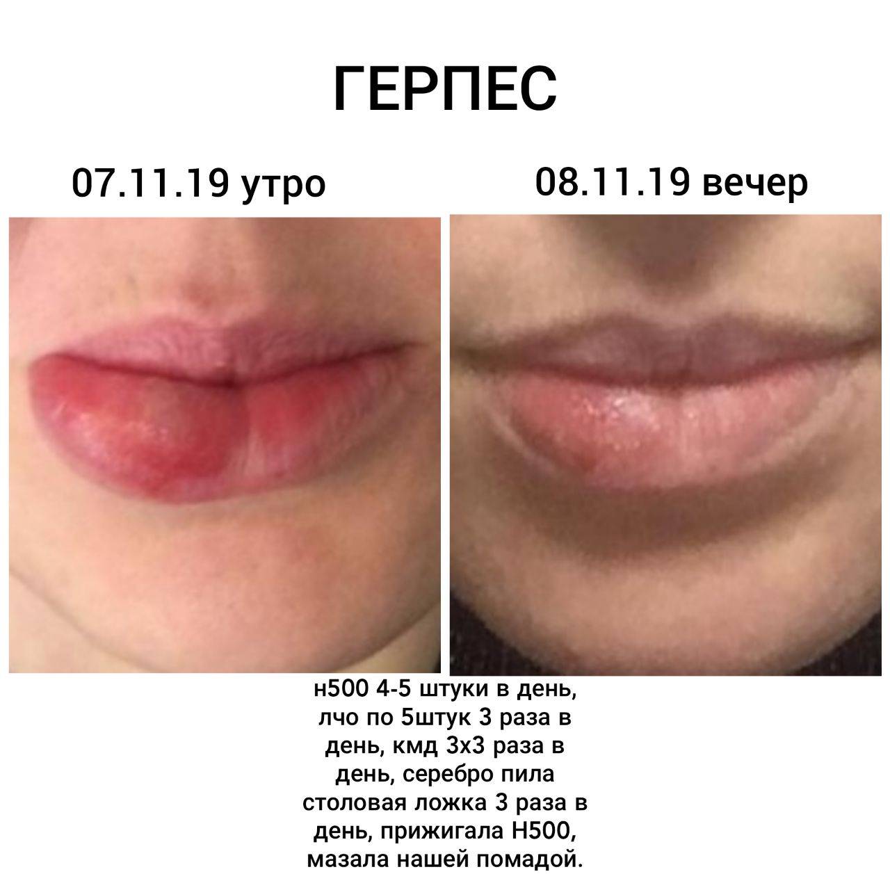 Герпес: разновидности, лечение и профилактика