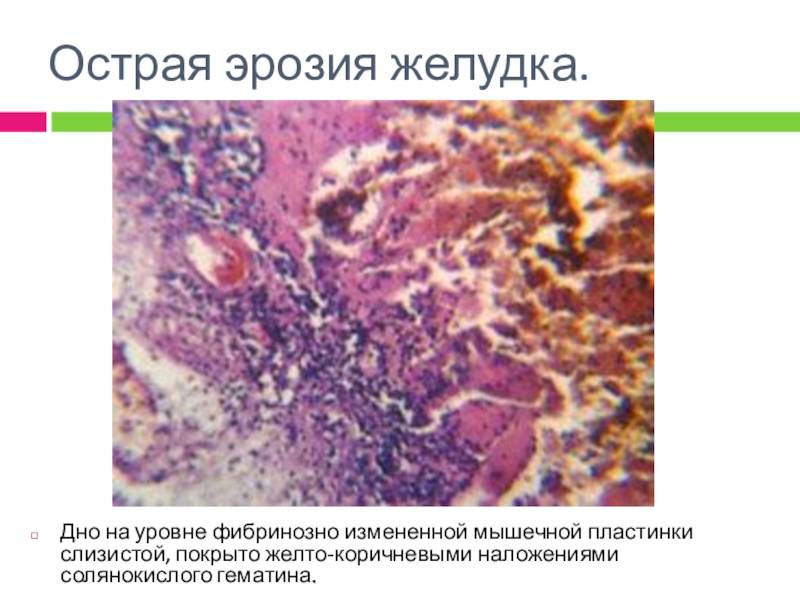 Язвенный гастрит: признаки и лечение