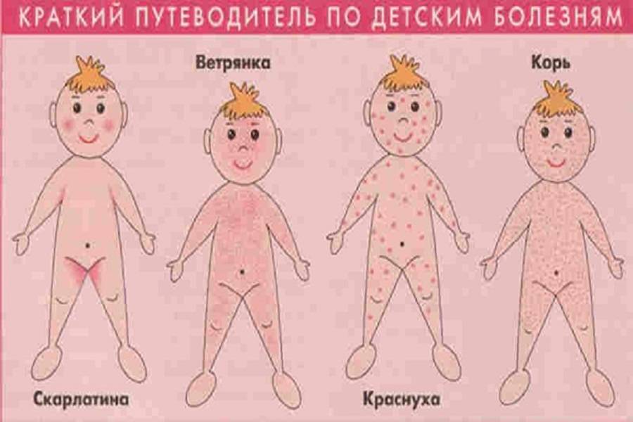 Болезни похожие на ветрянку: какие заболевания у детей могут напоминать оспу, как распознать причину по сыпи? прыщи но не ветрянка - какая болезнь? | moninomama.ru