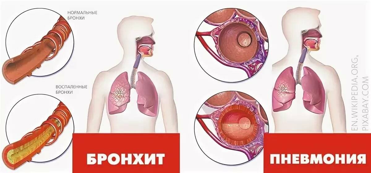 Чем отличается воспаление легких от бронхита - отличительный признаки и симптомы