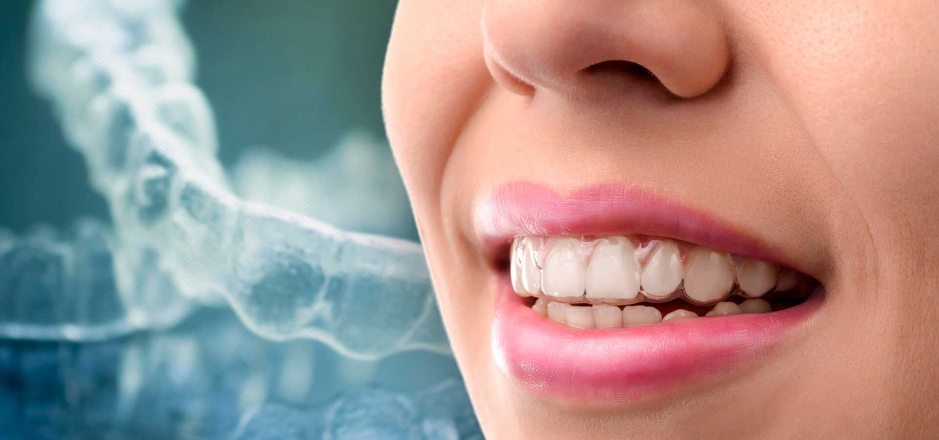Каппы invisalign