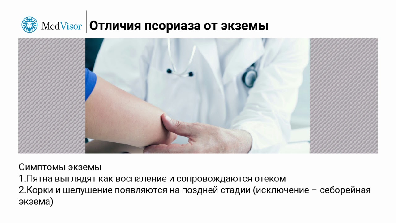 Как отличить просриаз от экземы?