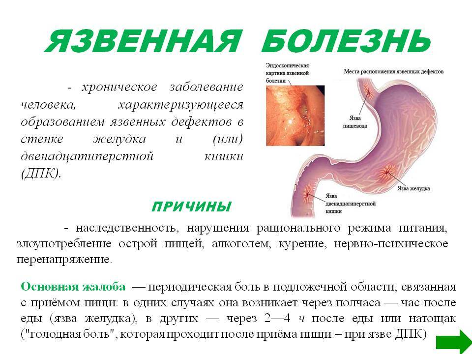 Чем отличается язва от гастрита