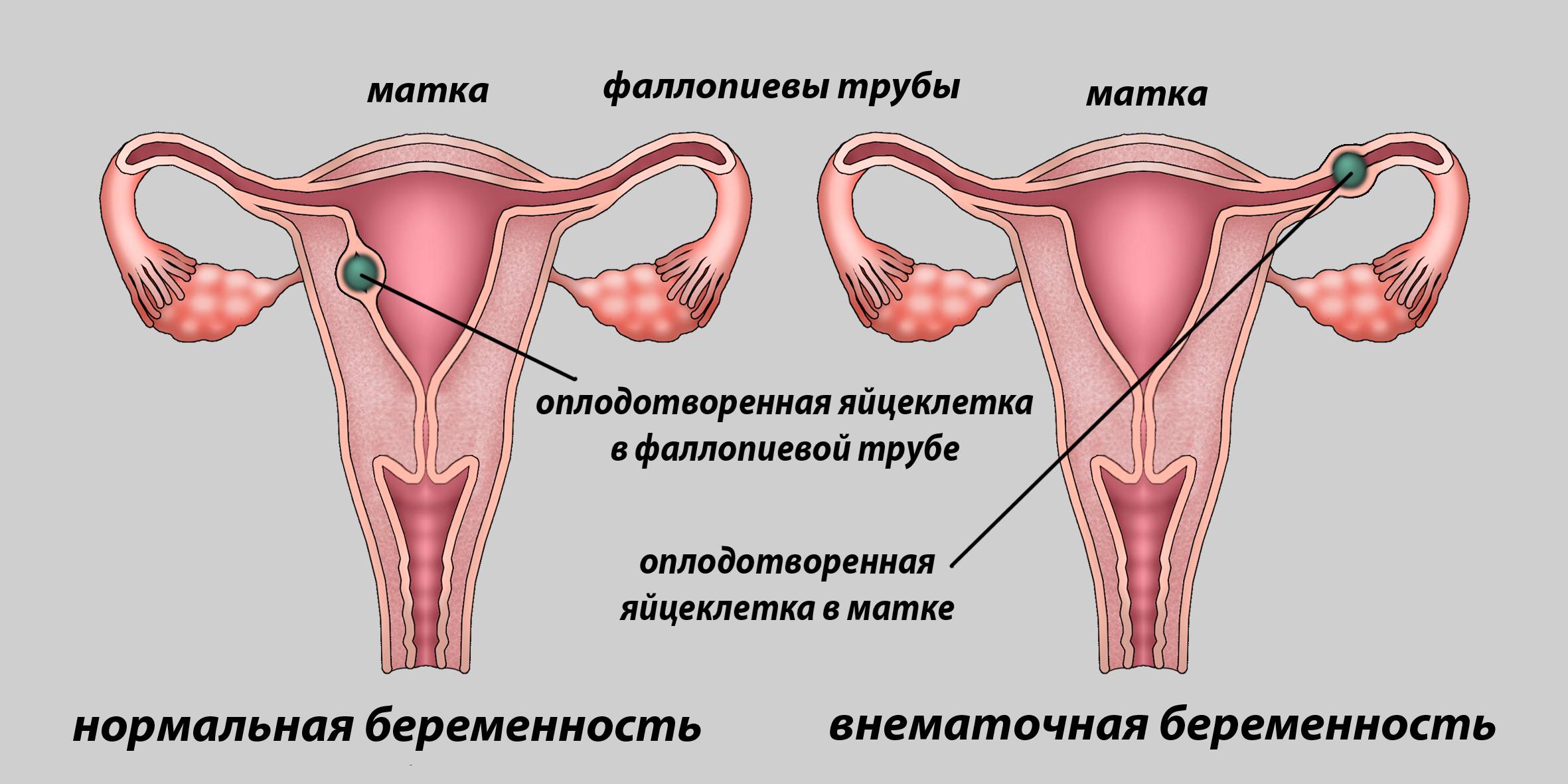 Внематочная беременность: симптомы и признаки – напоправку