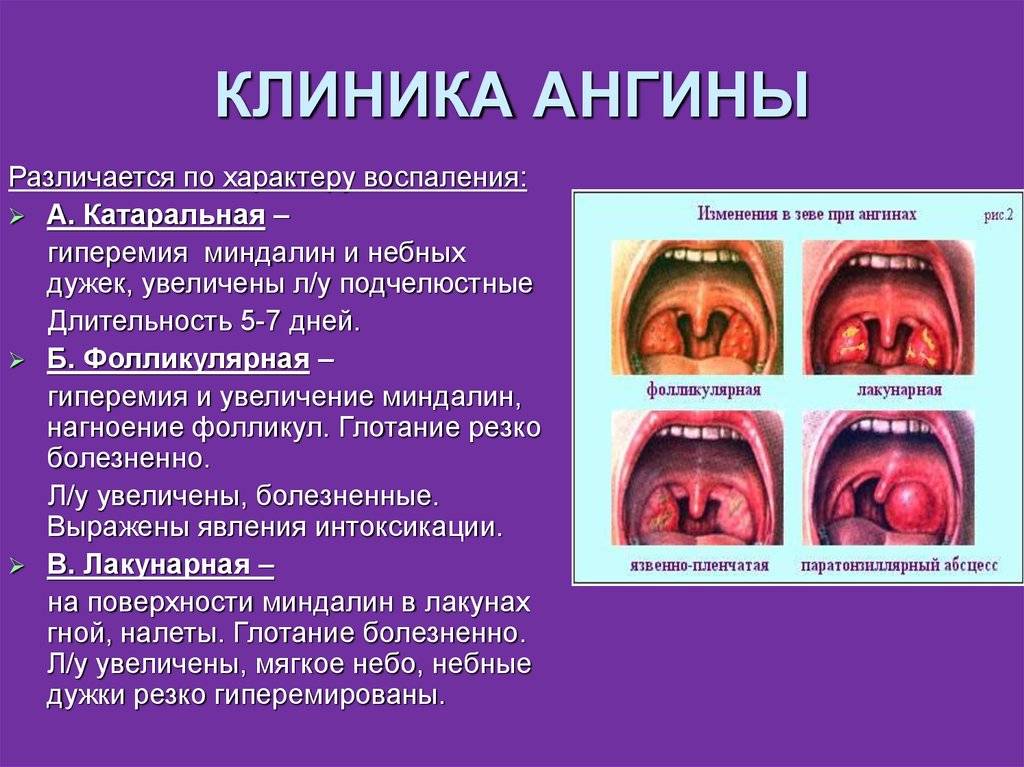 Ангина: симптомы, причины, виды и лечение ангины у взрослых