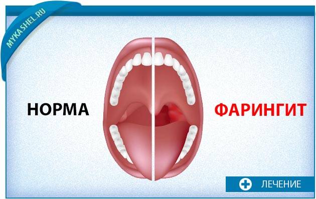 Фарингит и ларингит: отличия и сходства, причины, симптомы и лечение