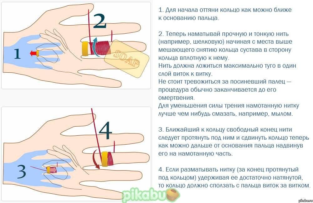 Как снять кольцо с опухшего пальца?