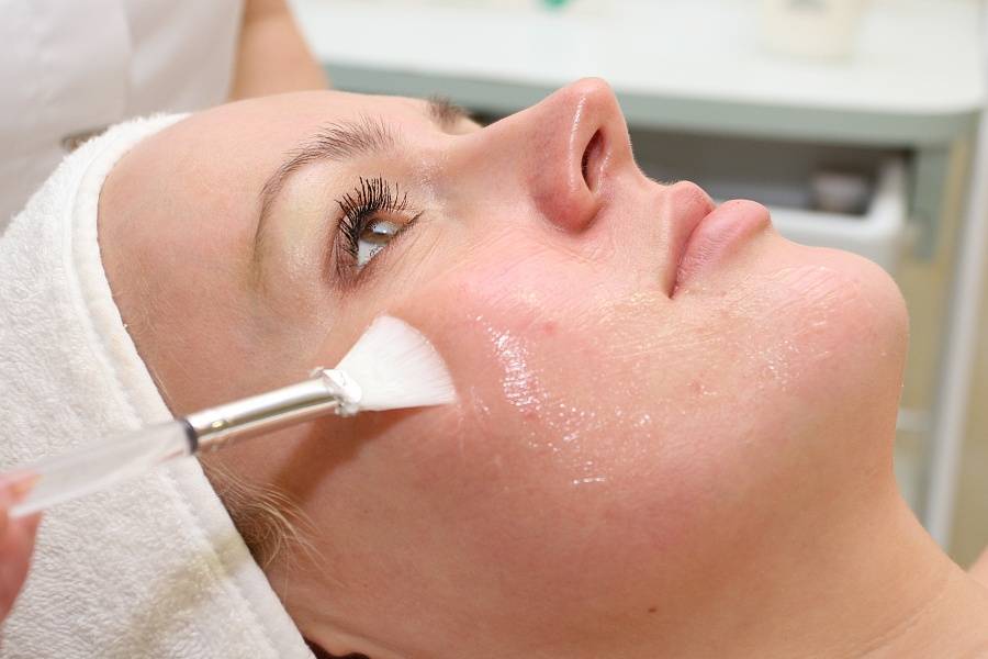 Пилинг с кислотой.