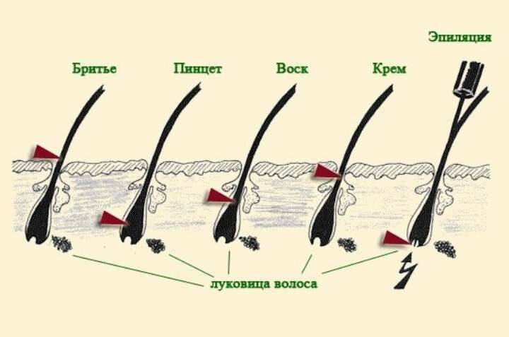 Способы удаления волос.