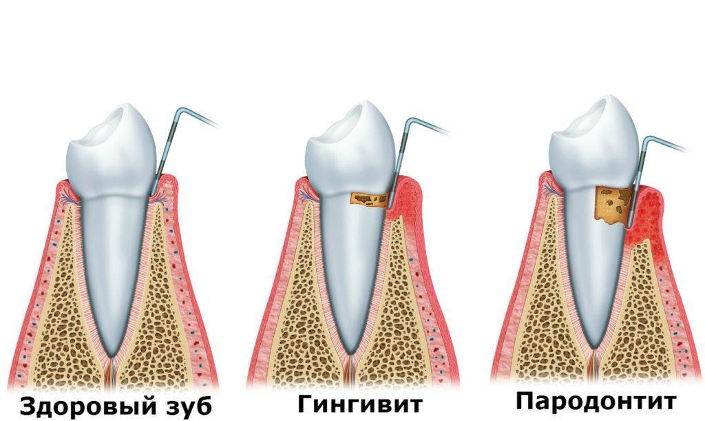 Здоровый зуб и пародонтит.