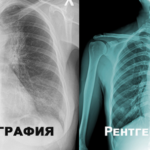 Флюорография и рентген.