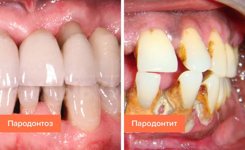 Пародонтоз и пародонтит.