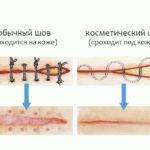 Косметический и обычный шов.