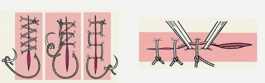 Обычные швы.