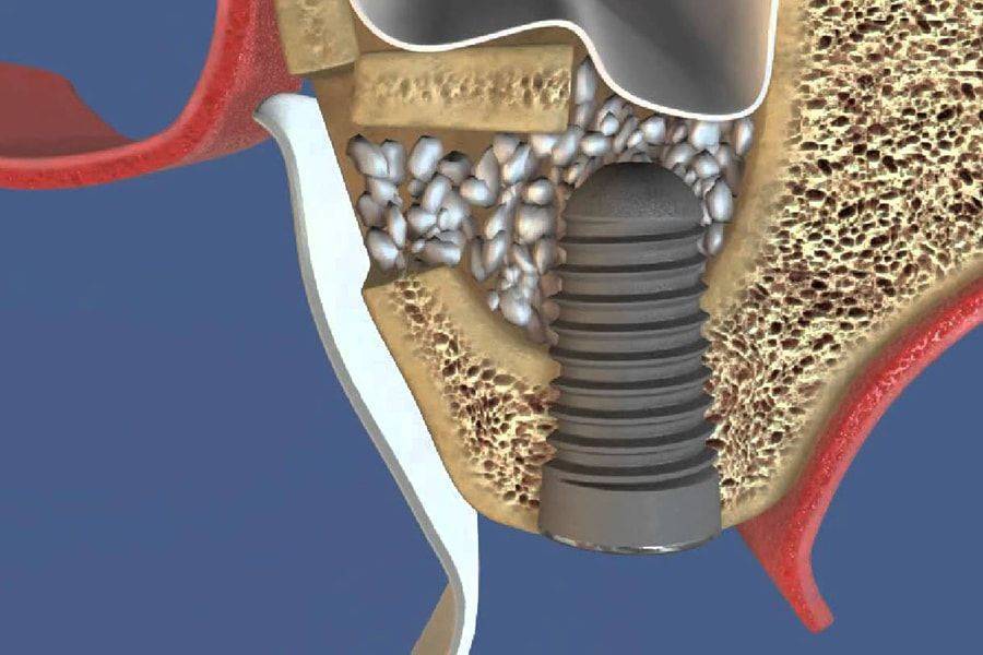 Открытый синус-лифтинг.