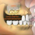 Синус-лифтинг.