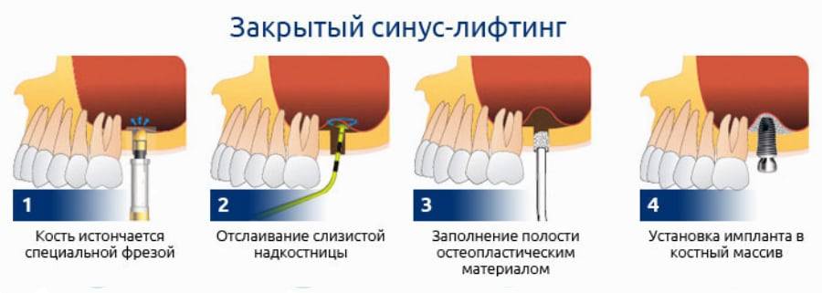 Закрытый синус-лифтинг.