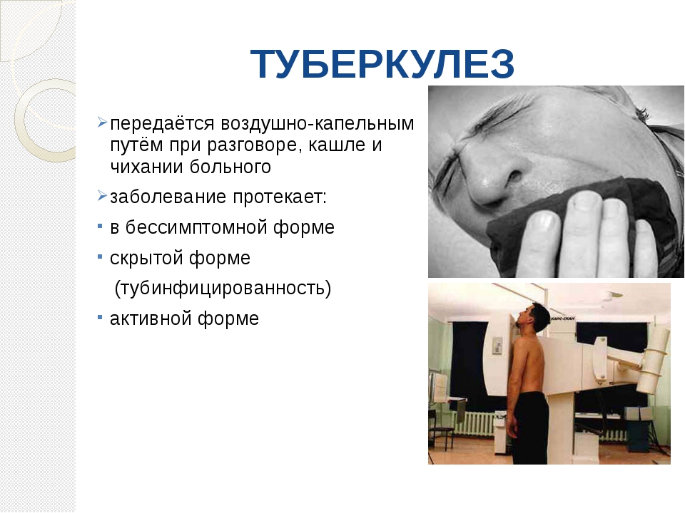 Первые симптомы туберкулёза
