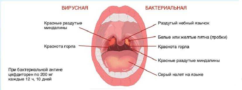 Виды ангины