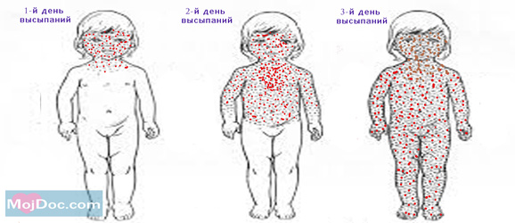 Как отличить ветрянку от кори: симптомы и особенности