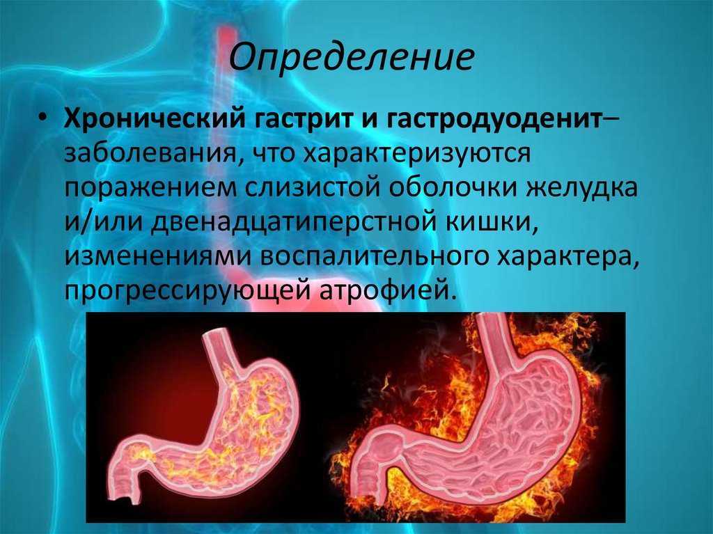 Гастрит и дуоденит: симптомы, диагностика и лечение