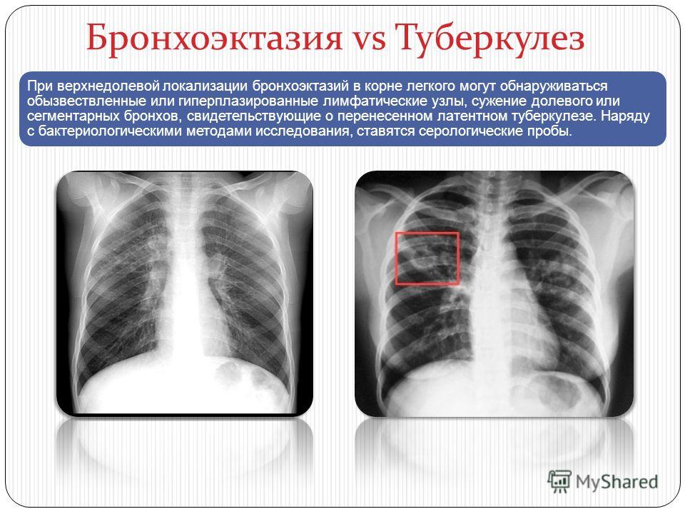 Кт легких или рентген, узи, мрт: выбираем самый точный метод диагностики