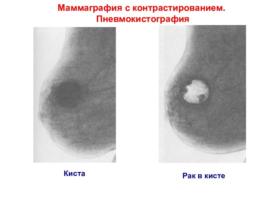 В чем разница между кистами и опухолями? - здоровье - 2024
