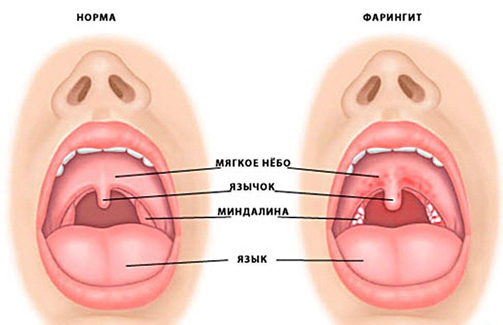 Чем отличаются фарингит, ангина и ларингит? (+отзывы)