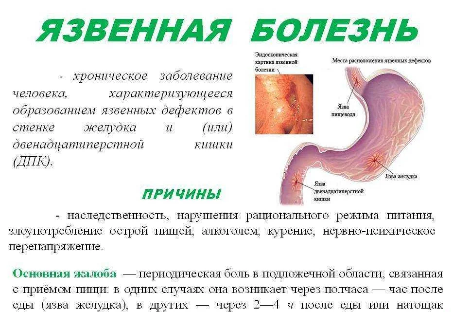 Анализ особенностей течения язвенной болезни желудка на фоне хронического атрофического гастрита | статья в журнале «молодой ученый»