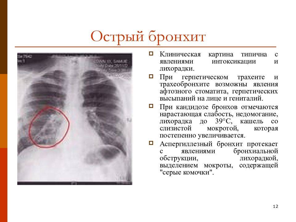 Как отличить бронхит от пневмонии у ребенка и взрослых
