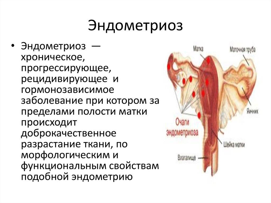 Эндометриоз: как диагностировать и лечить - klinik.by