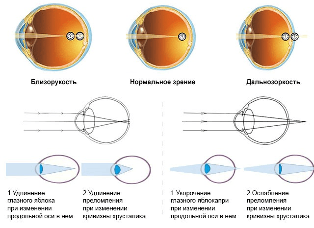Что такое дальнозоркость и близорукость: причины и симптомы патологий, их отличия и методы профилактики