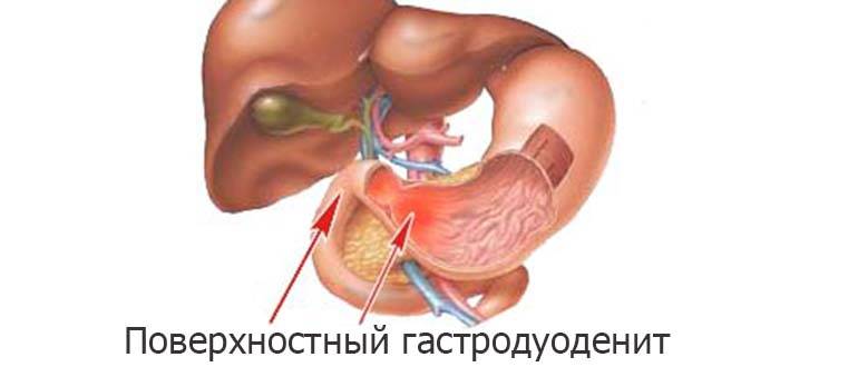 Хронический гастрит и дуоденит
