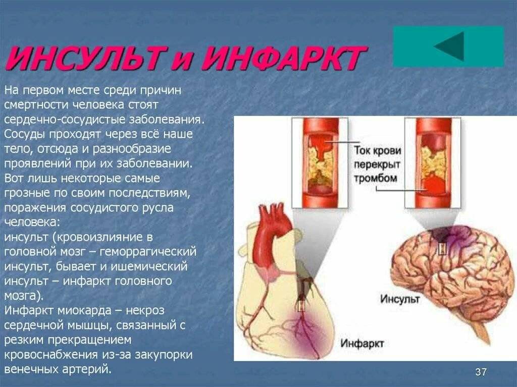 Чем отличается инсульт от инфаркта, в чем сходство