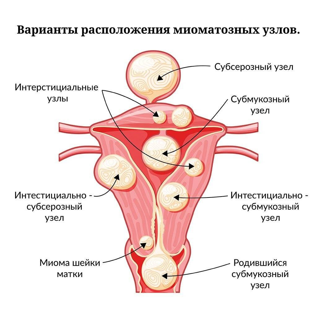 Фиброма и миома матки: в чем отличие?