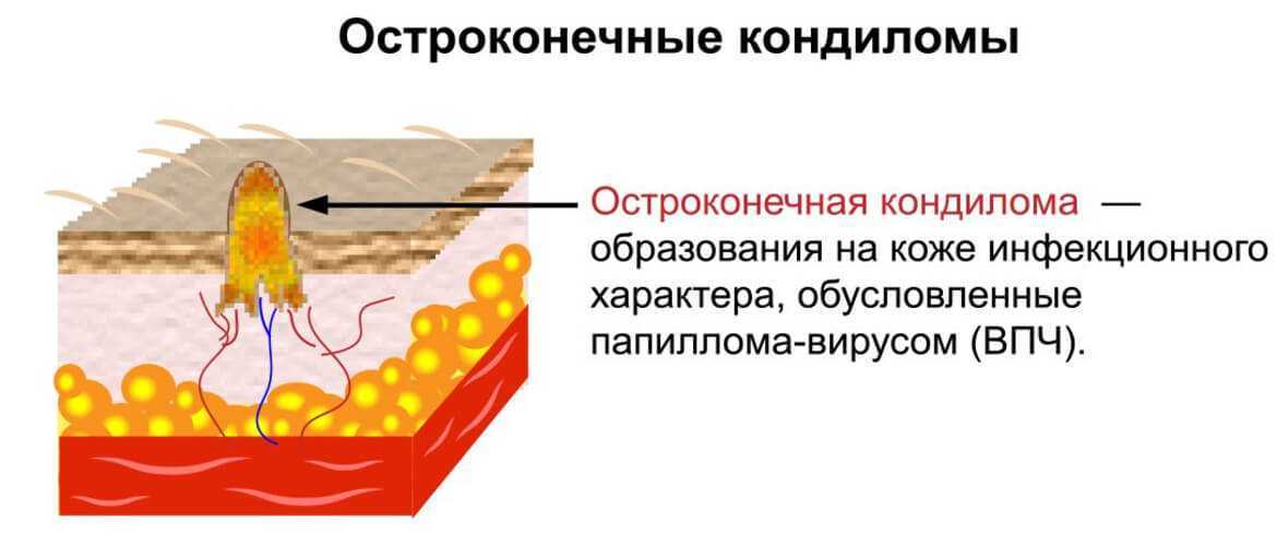 Кондиломы и папилломы: отличие