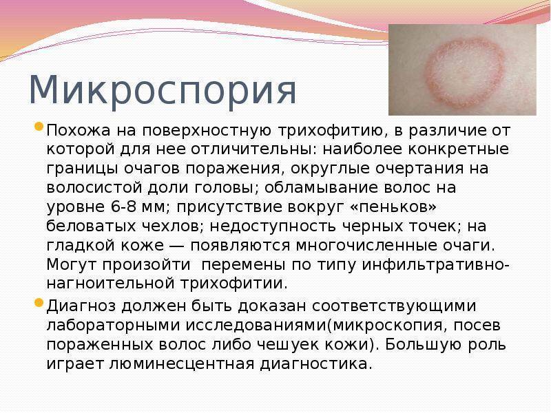 Как отличить лишай от аллергии?
