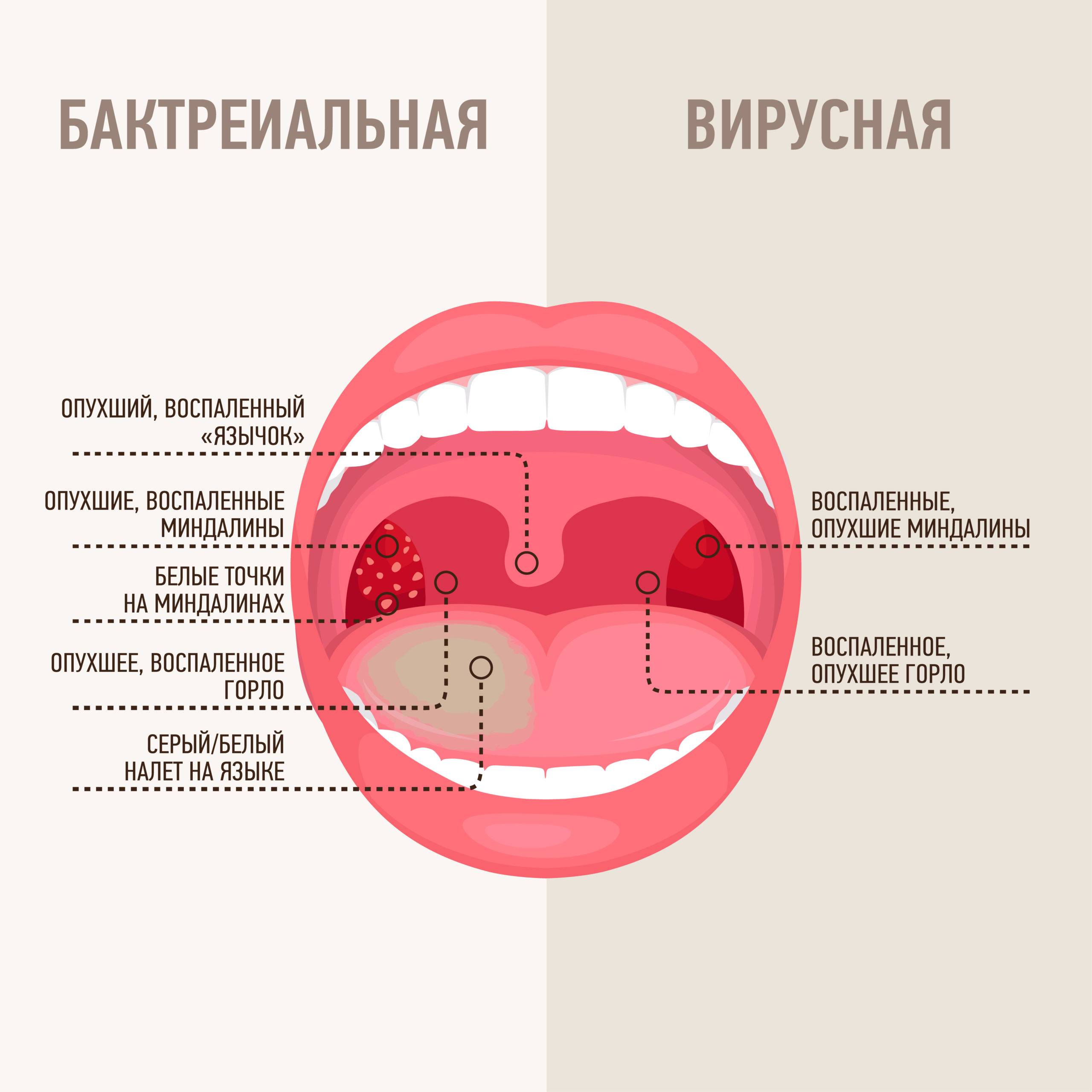 Тонзиллит, фарингит, ларингит – чем отличаются и как лечить
