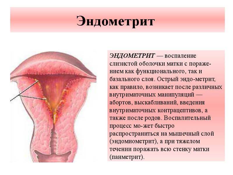 В чем разница между эндометритом и эндометриозом?
