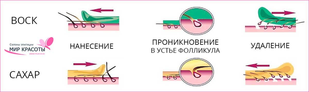Чем отличается депиляция от эпиляции волос