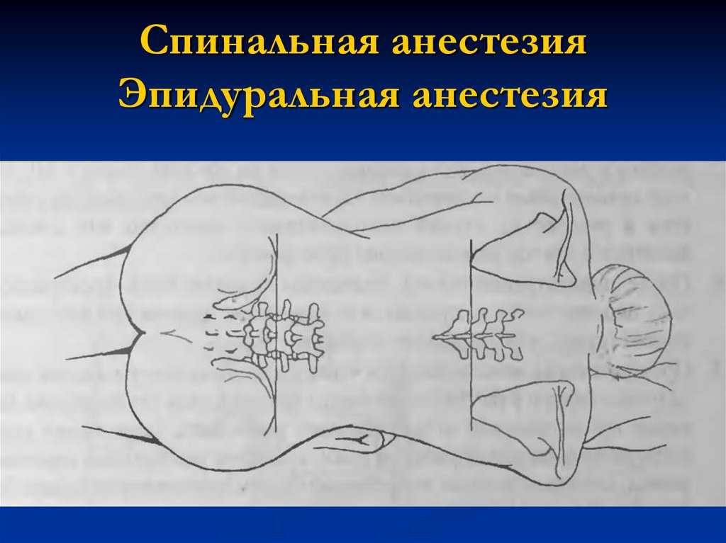 Эпидуральная анестезия и спинномозговая разница. чем спинальная анестезия отличается от эпидуральной? недостатки спинальной анестезии