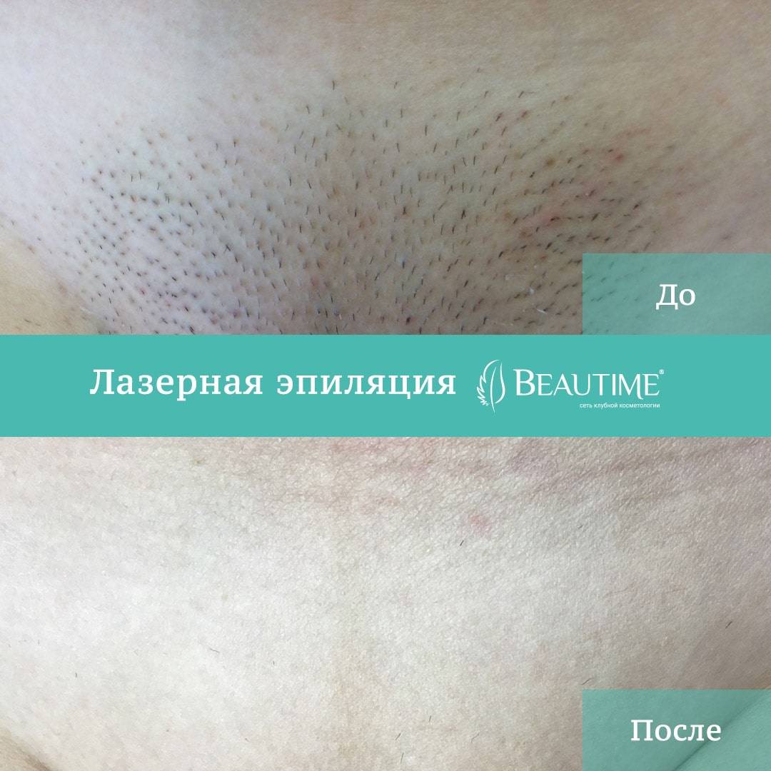 В чем отличие эпиляции от депиляции