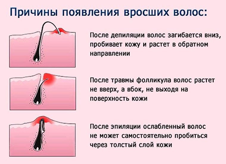 Как вытащить вросший волос?