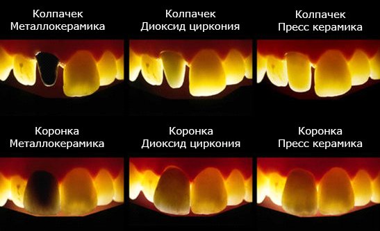 Отличия металлокерамики от обычной керамики