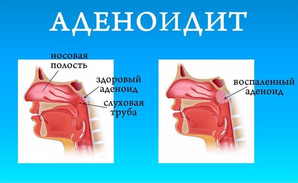 Гланды и миндалины, аденоиды — в чем различия?