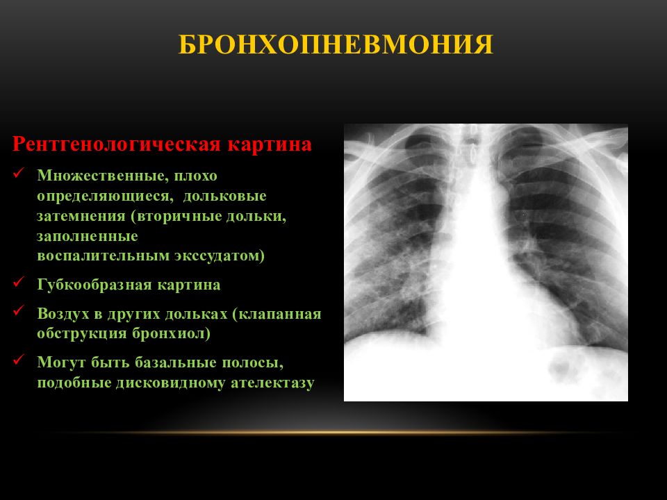 Чем отличается воспаление легких от бронхита - отличительный признаки и симптомы
